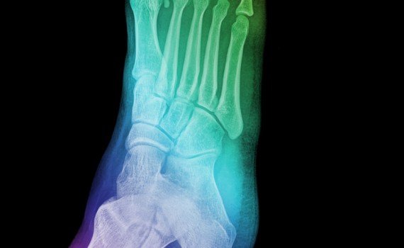 Broken Foot Lawyer