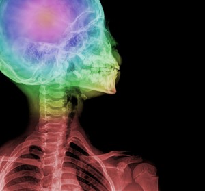 New York Brain Injury Lawyers