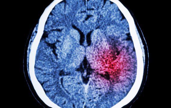 Swelling of Brain Lawyers