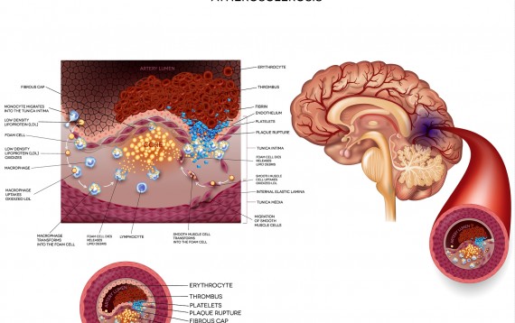 traumatic brain injury