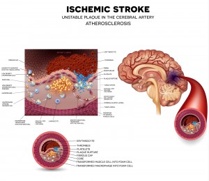 Eliquis Lawsuits for A-Fib Stroke Prevention Internal Bleeding
