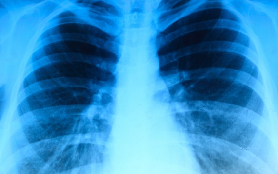 New York Lung Injury Lawyers