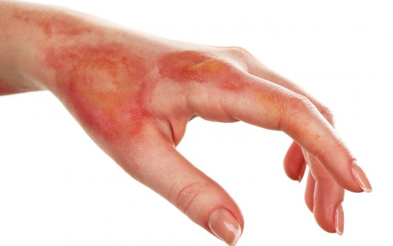 burn accident & injury attorneys
